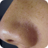 com.StatesApps.BlackHeadsRemedy