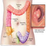 appinventor.ai_raziehghafouri.colorectal_cancer